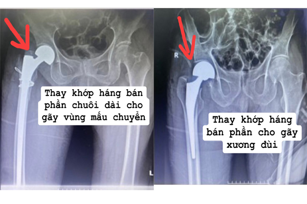 “Nên” hay “Không nên” thay khớp háng cho người cao tuổi Thay khớp háng ở người cao tuổi