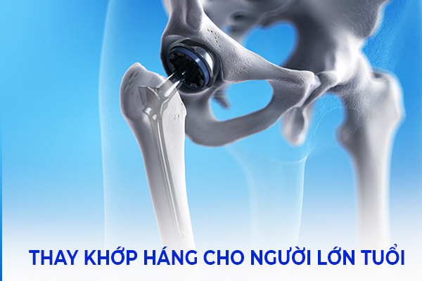 “Nên” hay “Không nên” thay khớp háng cho người cao tuổi