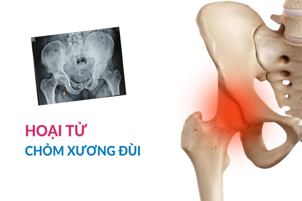 Hoại tử chỏm xương đùi: Nguyên nhân, triệu chứng, cách điều trị