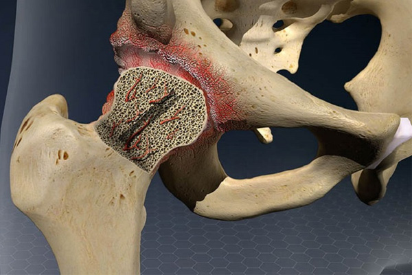 Hoại tử chỏm xương đùi: Nguyên nhân, triệu chứng, cách điều trị Nếu hoại tử chỏm xương đùi không được phát hiện và điều trị kịp thời sẽ có thể gây đau đớn nặng nề