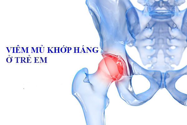 Viêm mủ khớp háng ở trẻ em