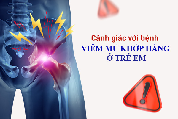 Những điều cần biết về viêm mủ khớp háng ở trẻ em viem mu khop hang o tre em 3