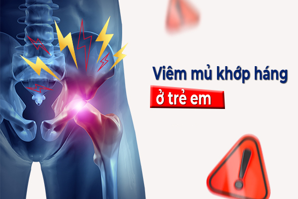 Viêm mủ khớp háng ở trẻ em: Bệnh lý nguy hiểm cần phát hiện sớm