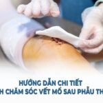 Hướng dẫn chi tiết cách chăm sóc vết mổ sau phẫu thuật