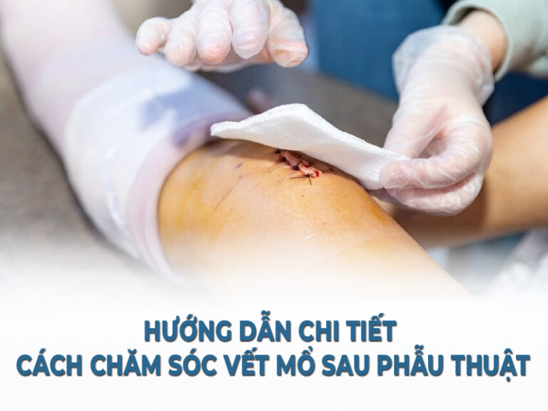 Hướng dẫn chi tiết cách chăm sóc vết mổ sau phẫu thuật